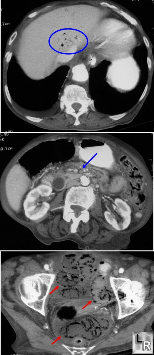 Mesenteric Vascular Ischemia
