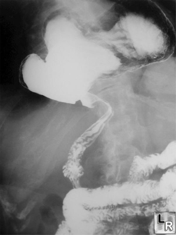 gastric volvulus, organoaxial