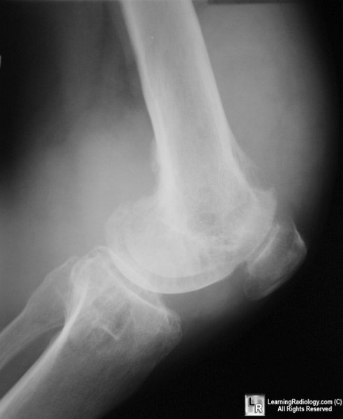 pvns, pigmented villonodular synovitis