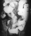 Lymphoma