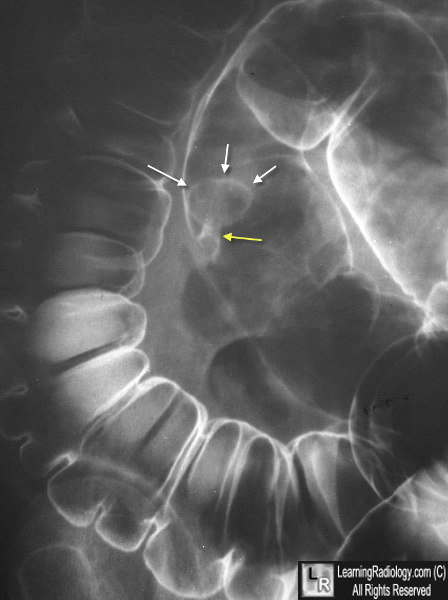 colon polyp