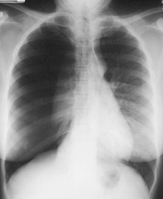 PTX-tension-frontal chest