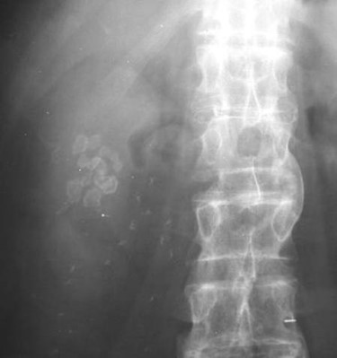 Gallstones-faceted