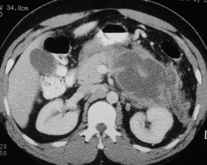 pancreatitis2