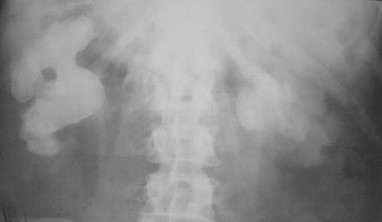 Staghorn calculi