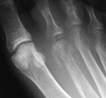 Osteo2