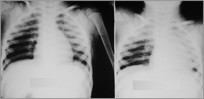 Obstructive emphysema-no words