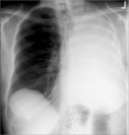 Atelectasis-left lung-BrCa-R3