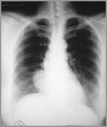 Thymoma PA