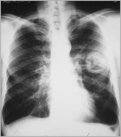 Cavity ca