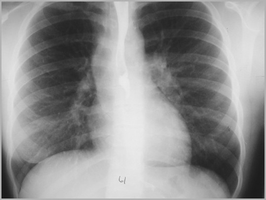 Aortic Stenosis2