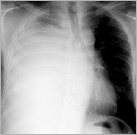Effusion-pleural-large-R-BrCa-R3