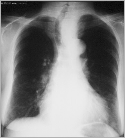 Thyroid enlargement-tracheal deviation